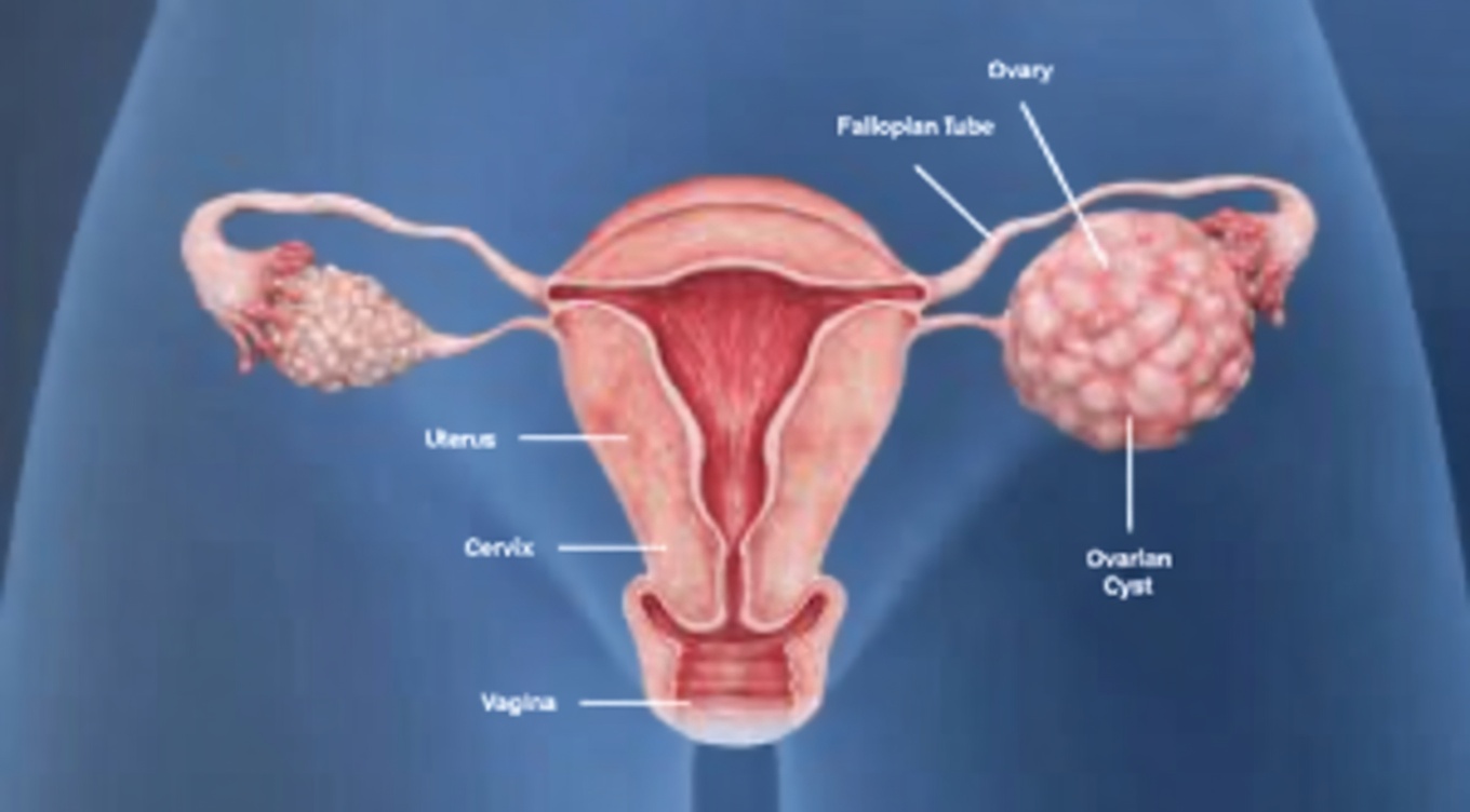 8 Silent Signs of Ovarian Cancer Every Woman Needs to Know (And Why Early Awareness Saves Lives)