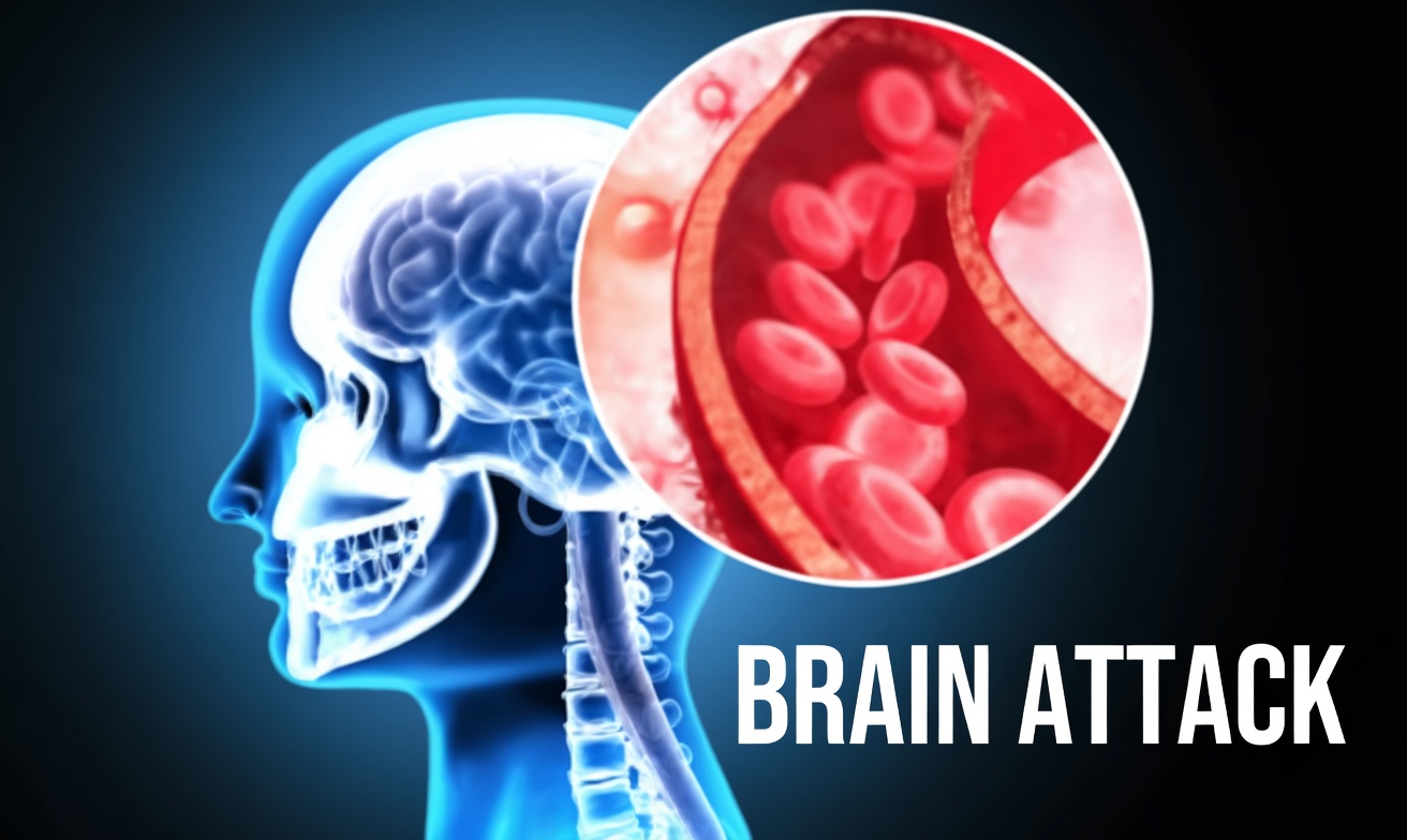 7 Lacunar Stroke Warning Signs in People Over 60 That Everyone Overlooks, Especially Number 4