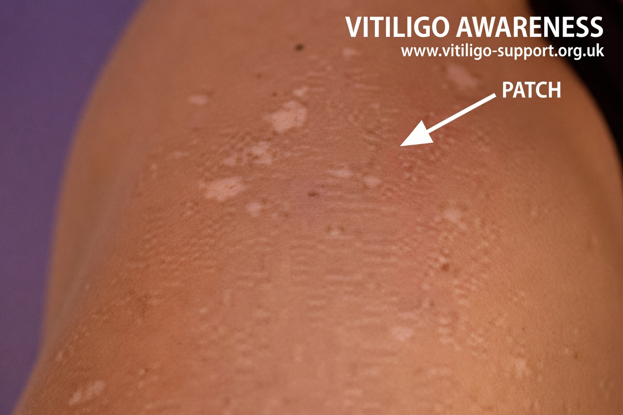 Have you noticed small white spots on your arms or legs… and you don’t know what they are?