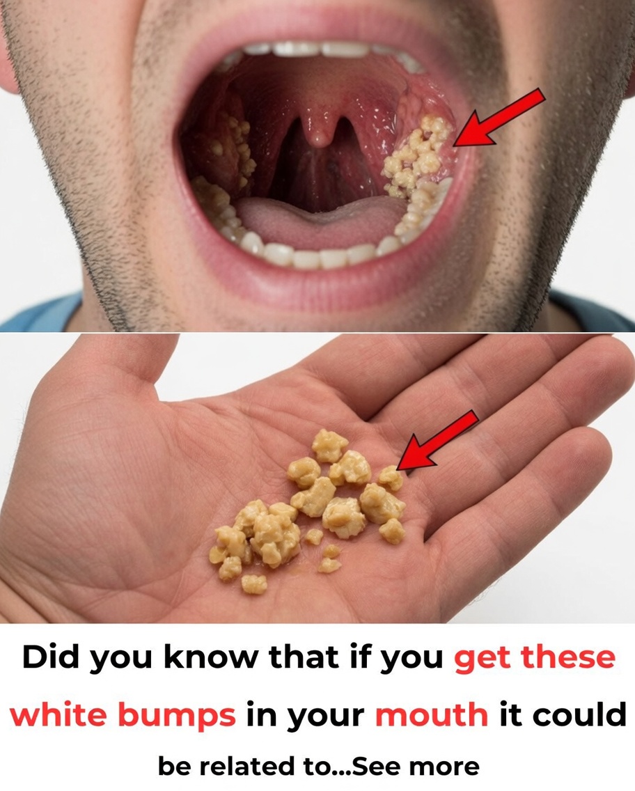 Tonsil Stones: Discover What They Are, How They Form, and How to Get Rid of Them Forever