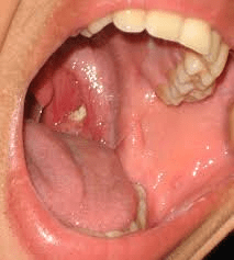 Tonsil Stones: Discover What They Are, How They Form, and How to Get Rid of Them Forever