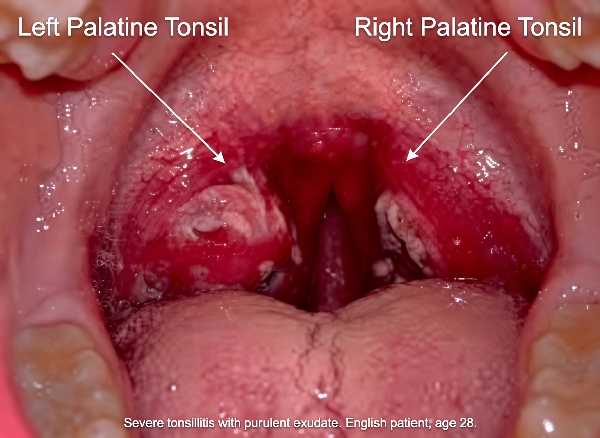 Tonsil Stones: Discover What They Are, How They Form, and How to Get Rid of Them Forever