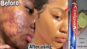 Colgate Toothpaste for Face Whitening with Lemon: What You Need to Know About This Popular Home Remedy