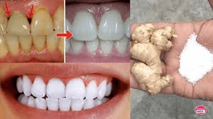 Whiten Your Teeth Instantly with This 2-Minute Ginger and Salt Trick. Here’s How