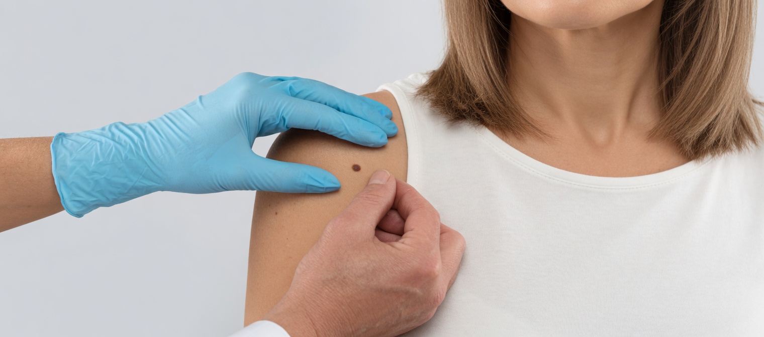 Best Natural Home Remedies to Safely Support Skin Tag Removal at Home (What Really Works and What to Watch Out For)