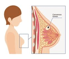 10 Warning Signs of Breast Cancer You Need to Know for Early Detection and Better Awareness