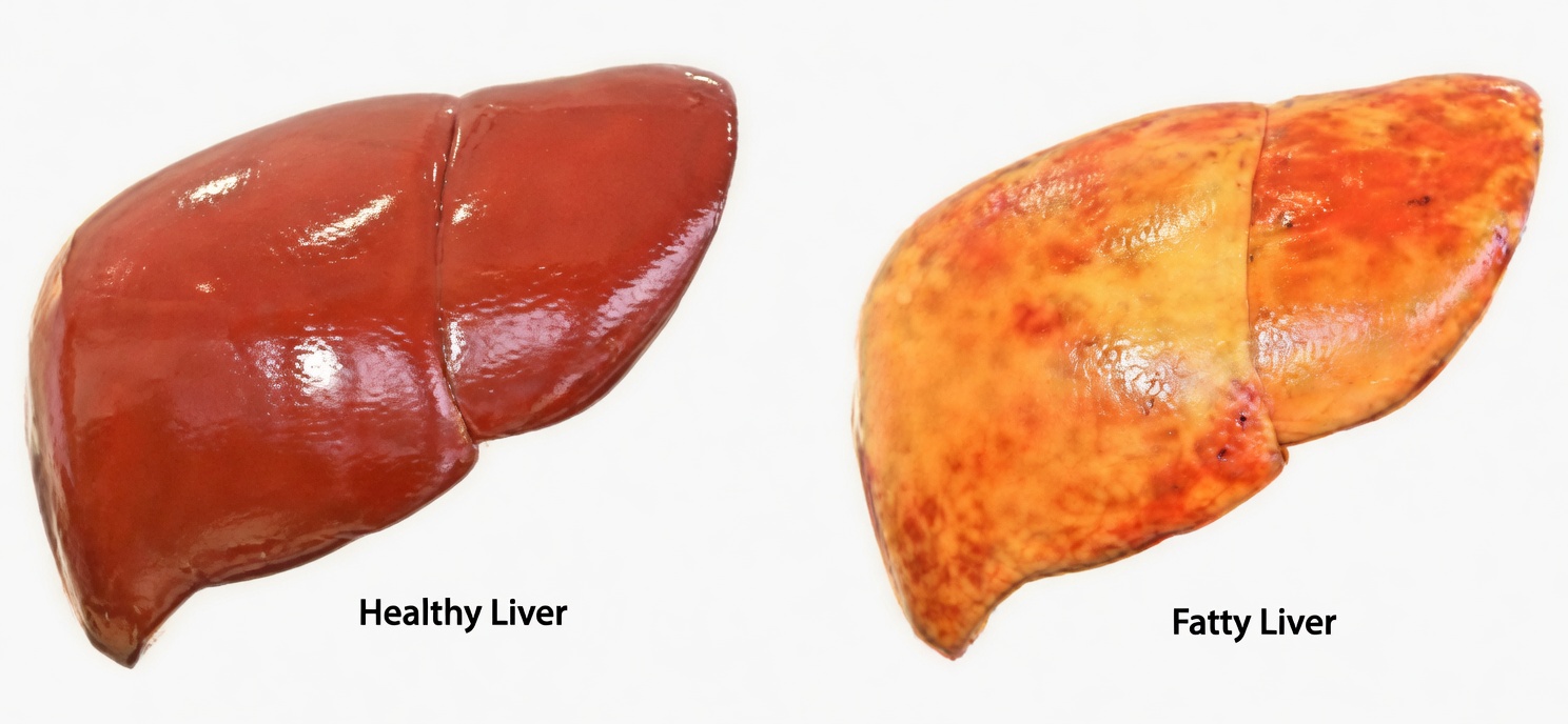 14 Potential Warning Signs of Fatty Liver You Might Notice: Plus Everyday Foods That May Support Liver Health