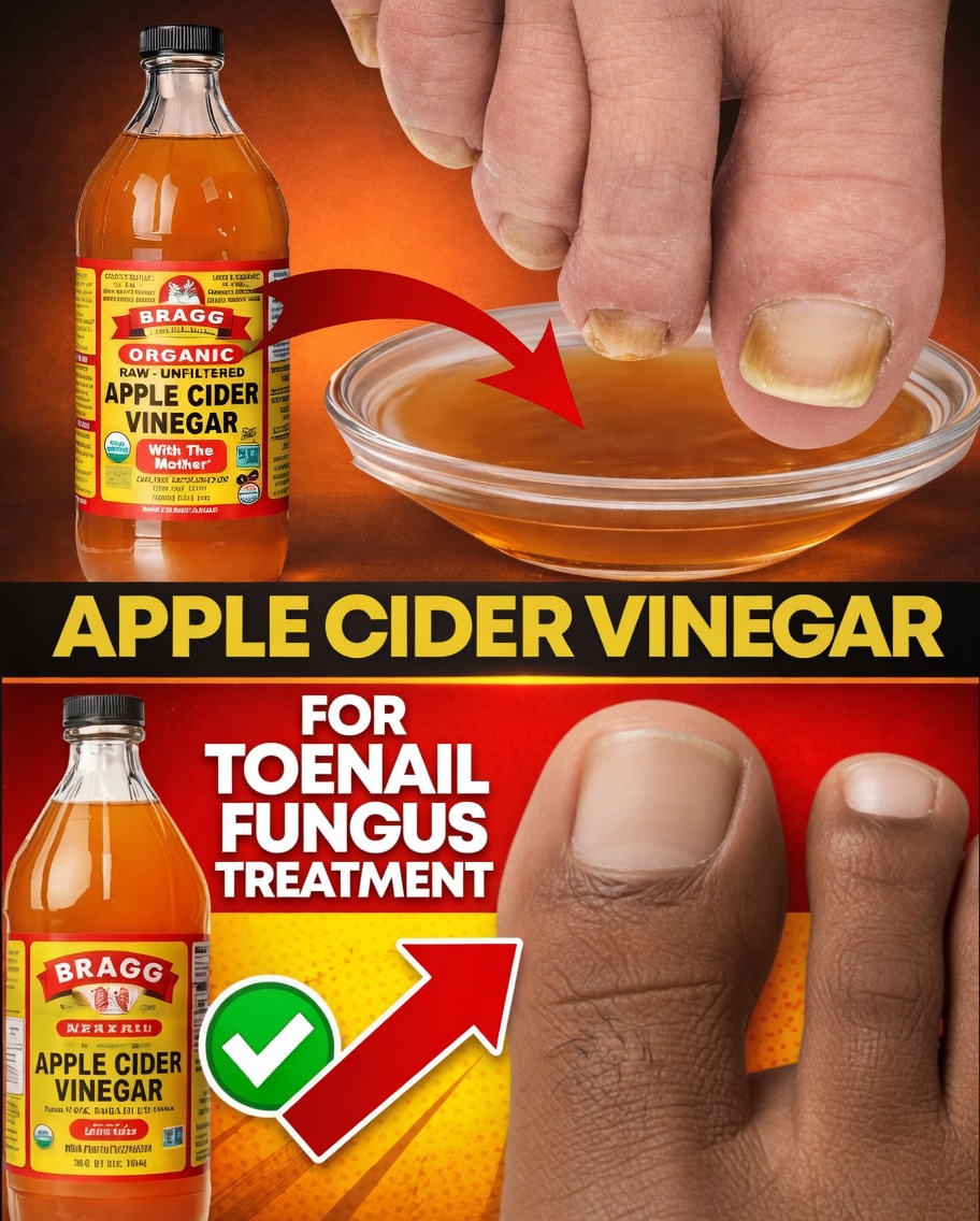 Toenail Fungus Treatment Using Apple Cider Vinegar: A Fast and Cheap Cure