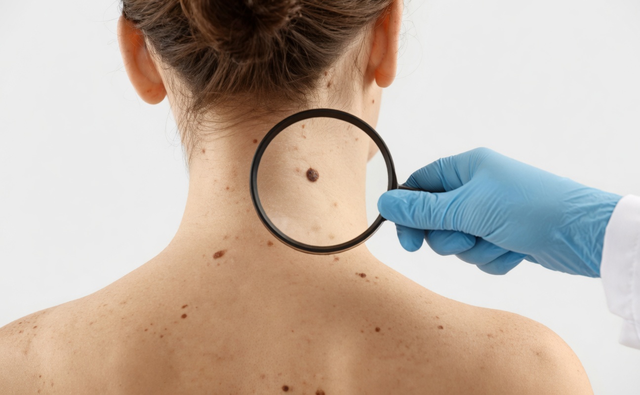 Say Goodbye to Warts & Skin Tags—The Natural Way That Works