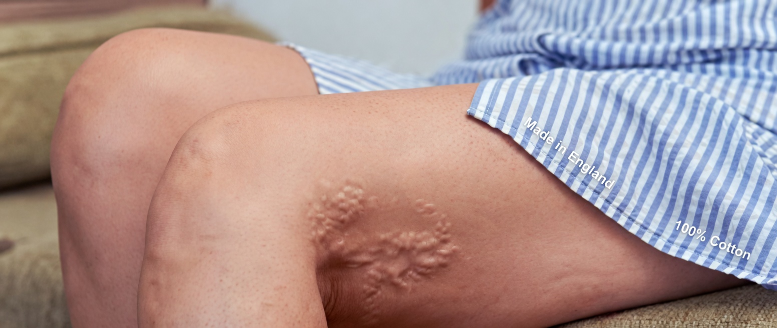 Grandma’s Natural Remedy for Varicose Veins