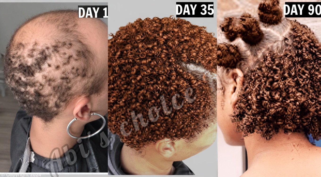 My Hair Was Completely Bald! Until I Started Using This Remedy — My Hair Grew Like Crazy & Skin Glows (Rice + Aloe Vera Mask)