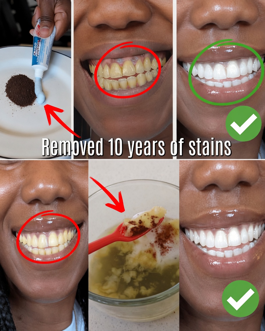In Just 2 Minutes, Remove 10 Years of Teeth Stains – The Natural Whitener That Actually Works