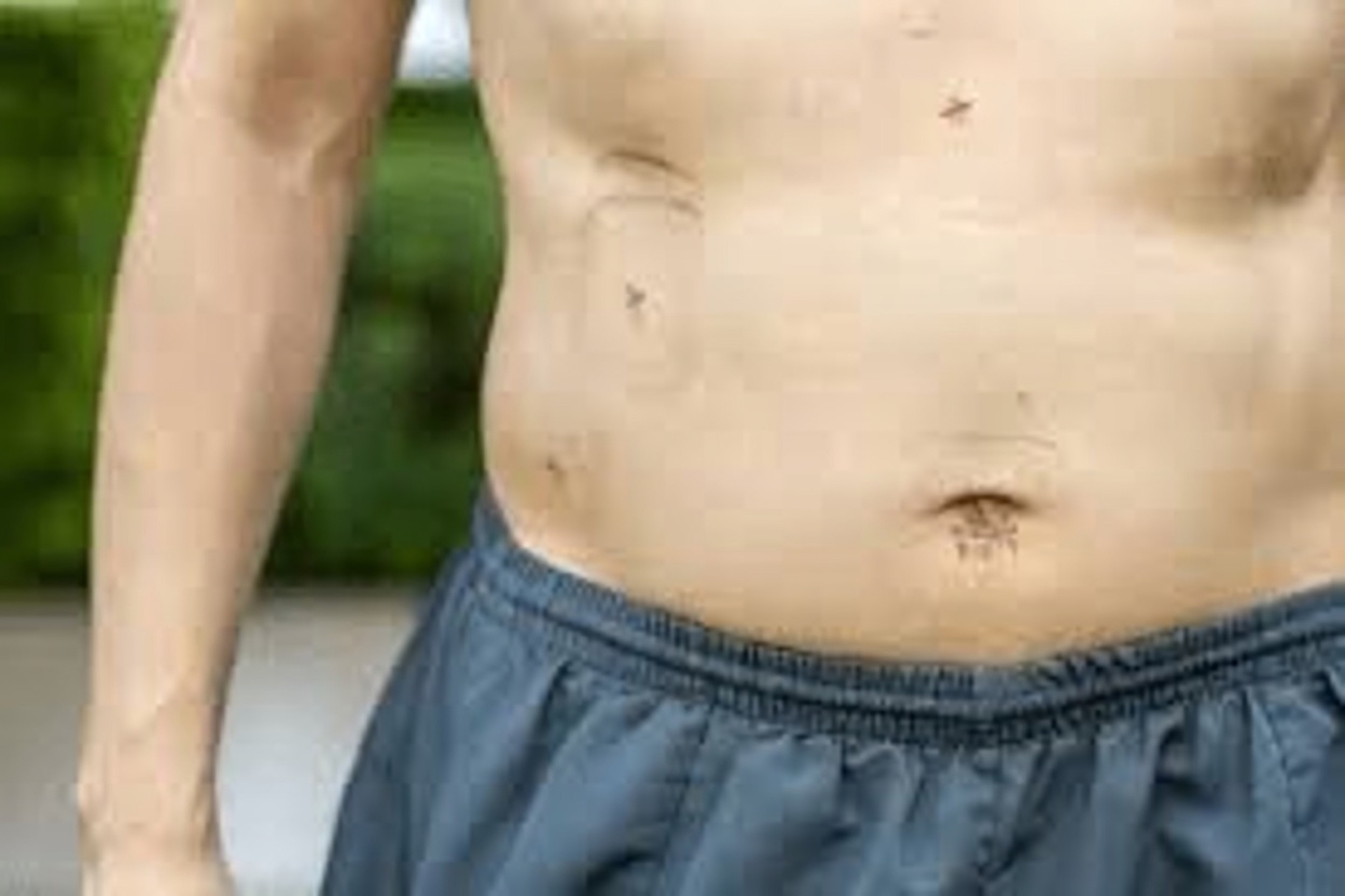 What Happens to Your Body After Gallbladder Removal