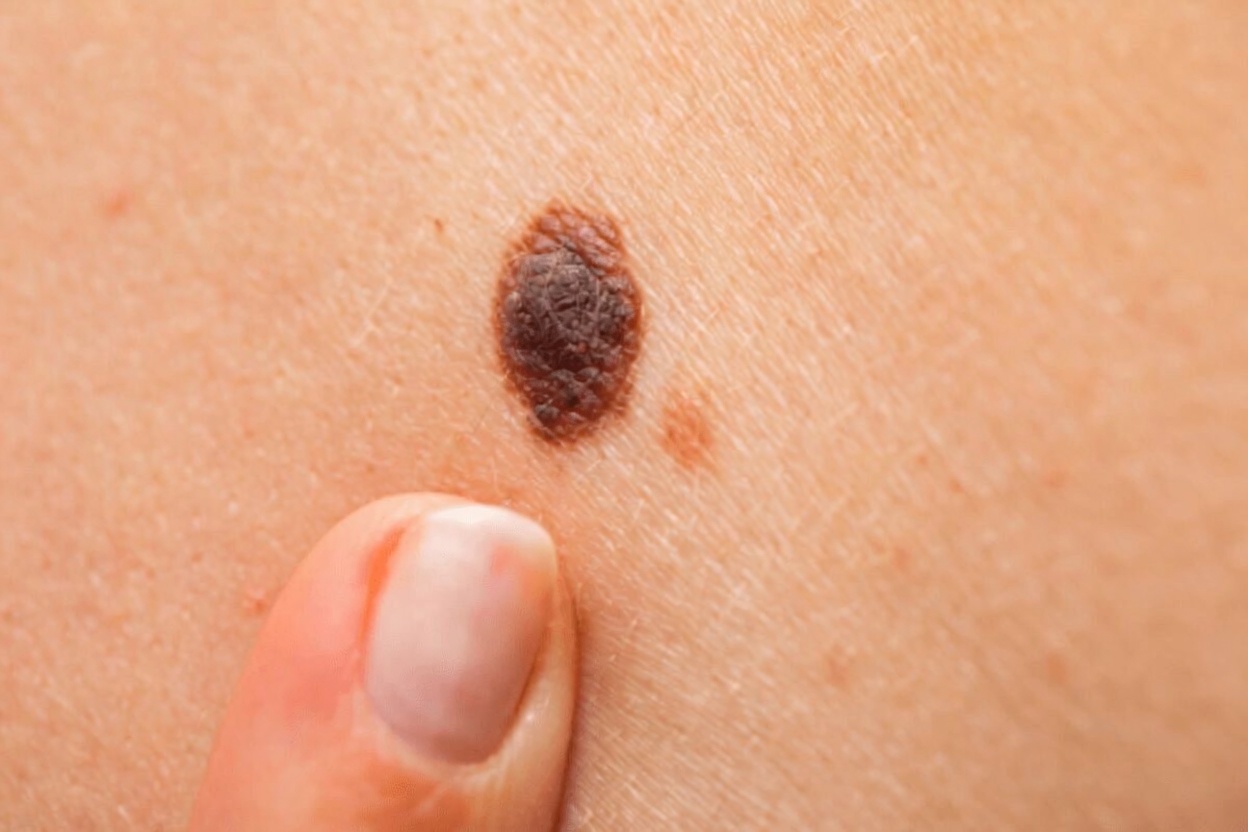 20 Early Warning Signs of Cancer You Should Never Ignore