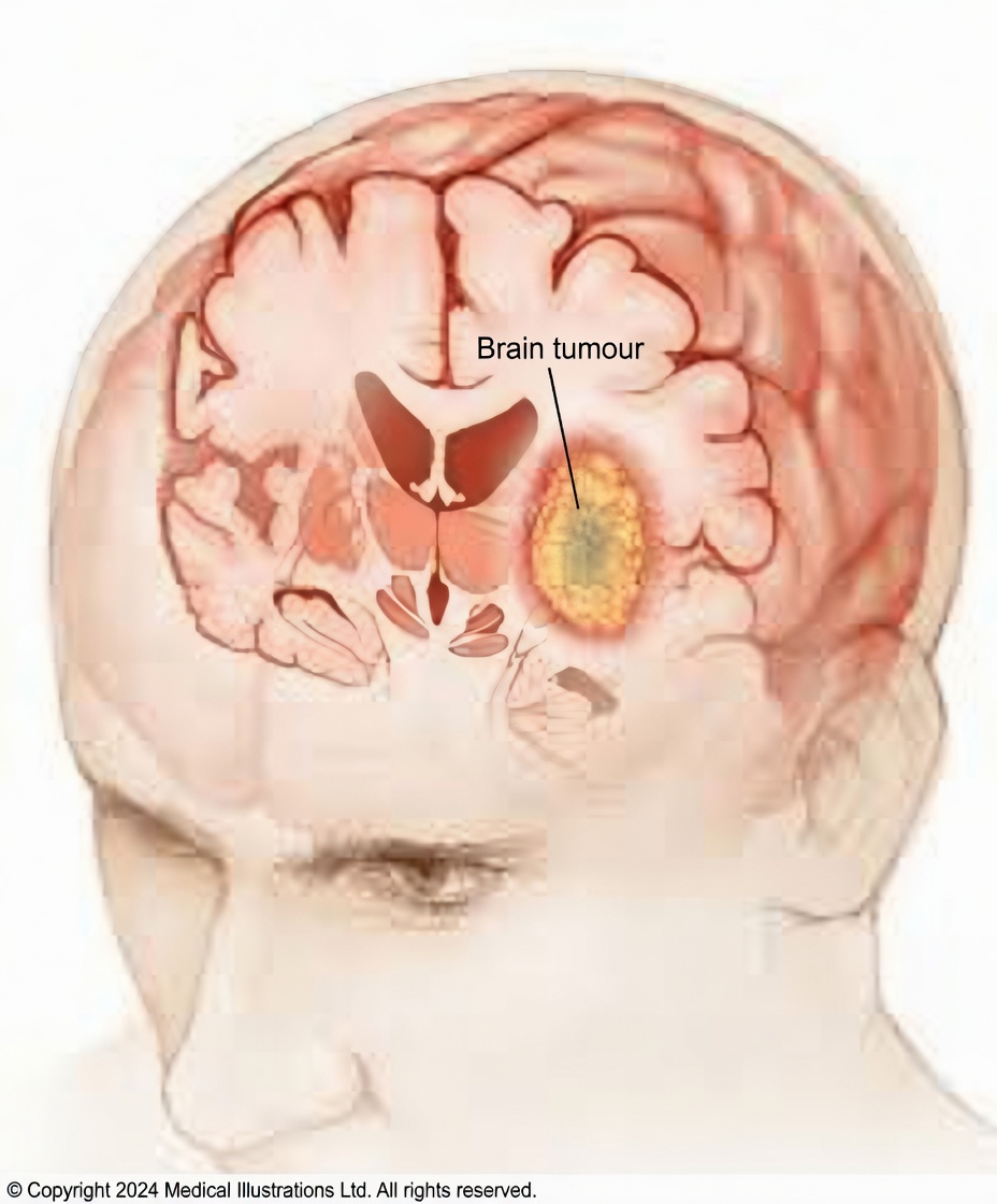 Don’t Miss These 8 Early Brain Tumor Signs – It Could Save You!