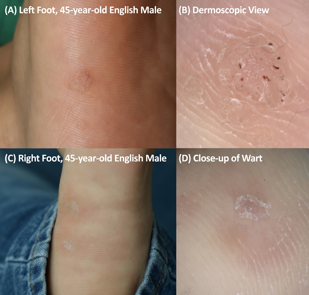 Can Banana Peel Really Help with Warts? A Gentle Look at This Simple Home Remedy