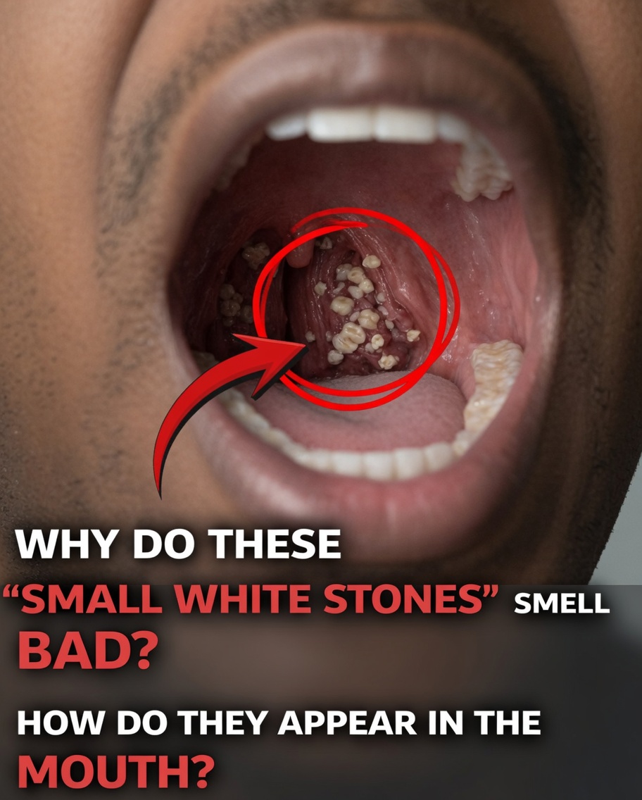 Understanding Tonsil Stones: What You Need to Know and How to Handle Them