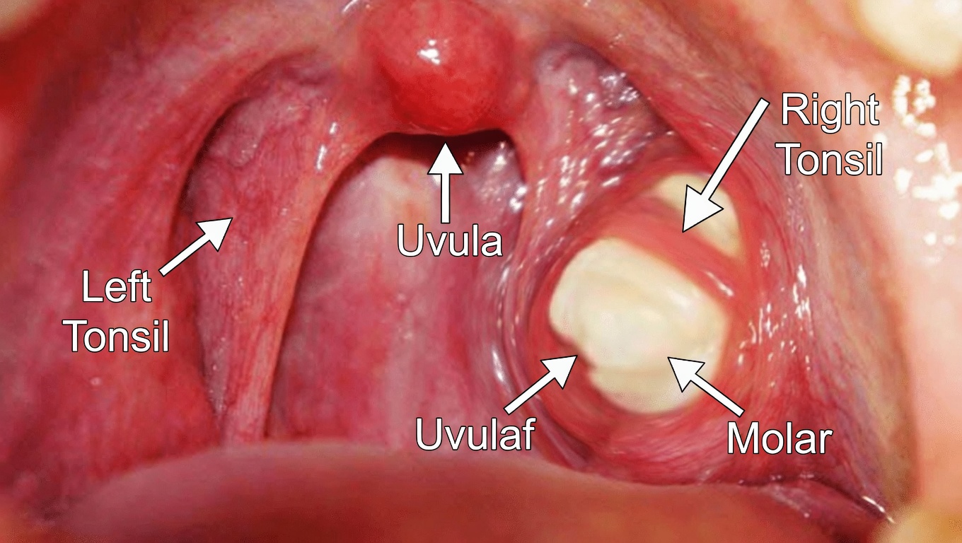 Understanding Tonsil Stones: What You Need to Know and How to Handle Them