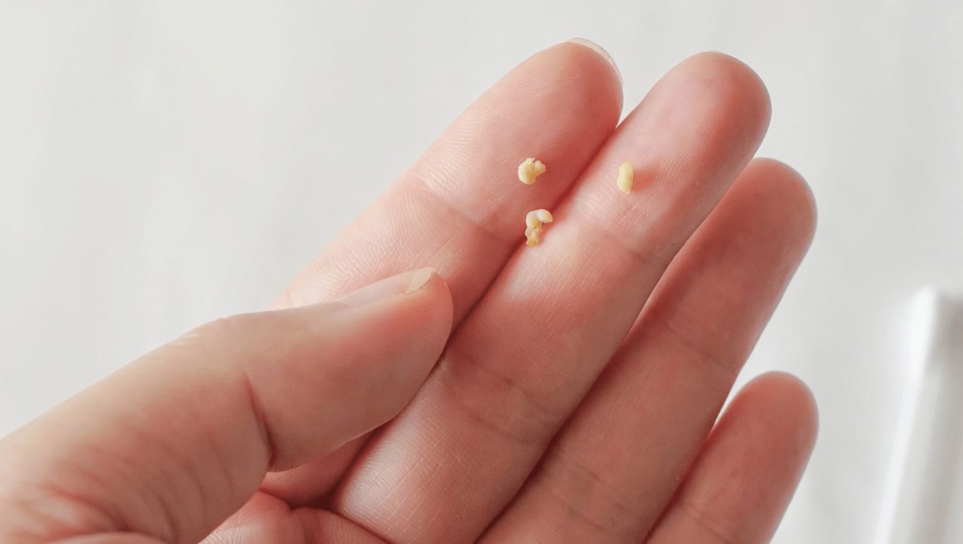 Understanding Tonsil Stones: What You Need to Know and How to Handle Them