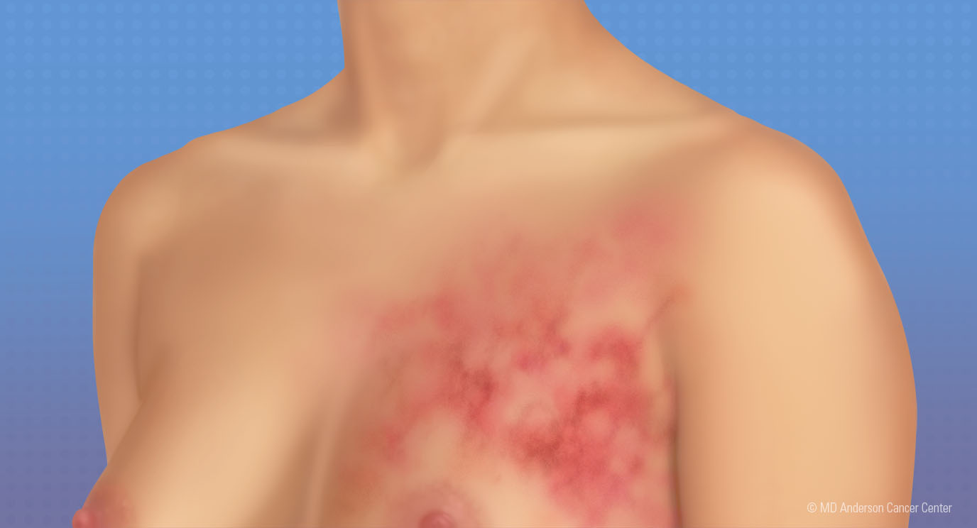 10 Warning Signs of Breast Cancer: Early Detection Could Save Your Life