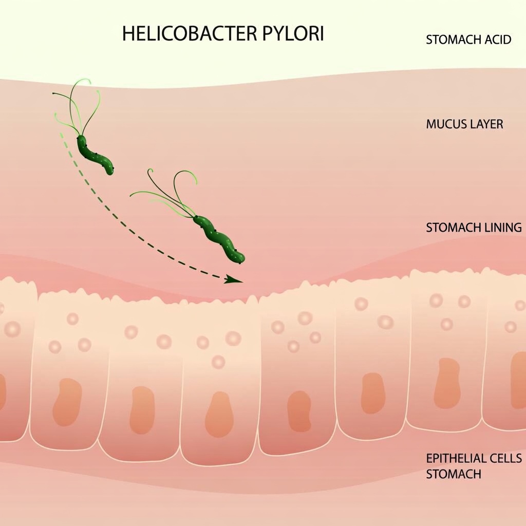 Helicobacter pylori Warning: Could This Quiet Stomach Germ Be Affecting You?
