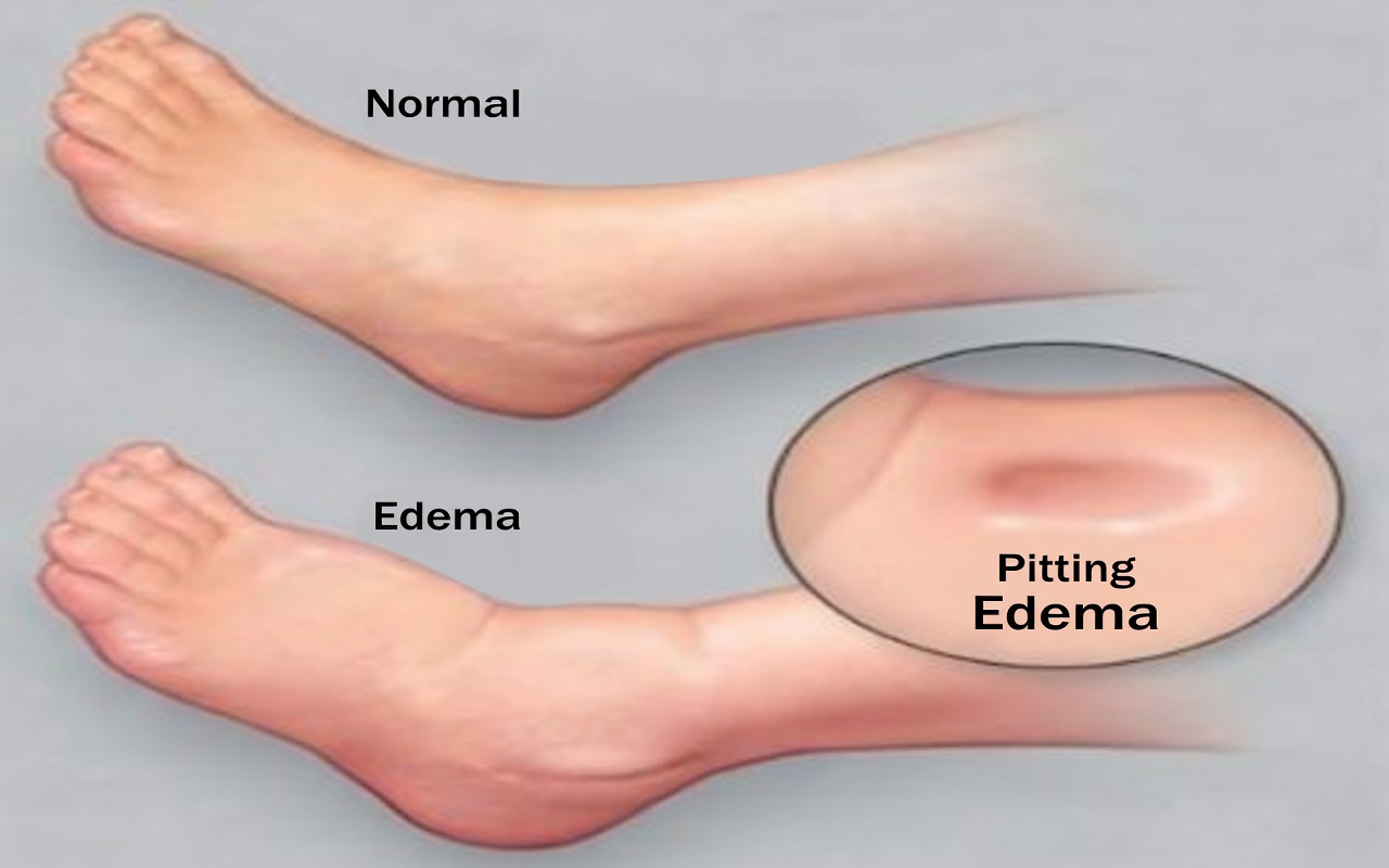 How Your Feet Are Warning You About Liver Problems: Don’t Miss These Subtle Signs