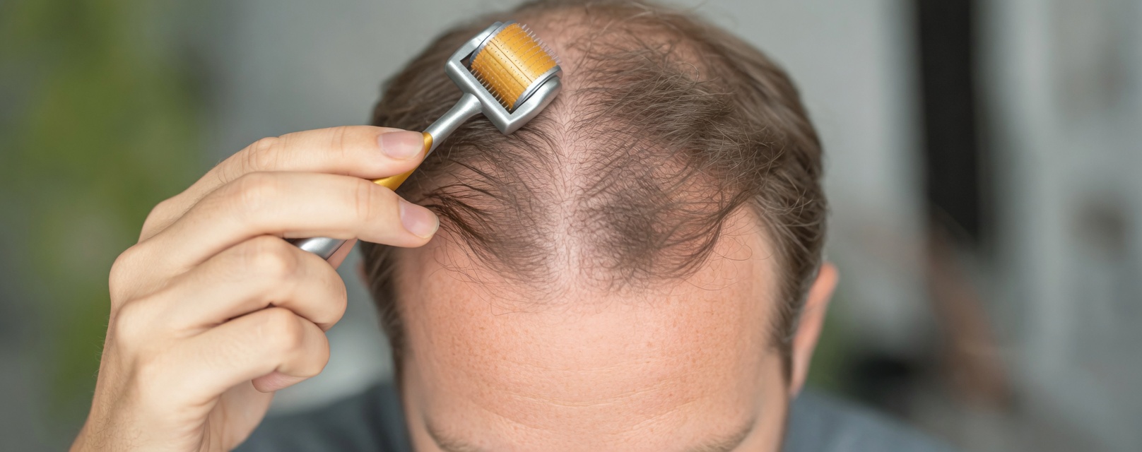 Myths and Realities About Hair Growth: Can You Regain Hair Density?