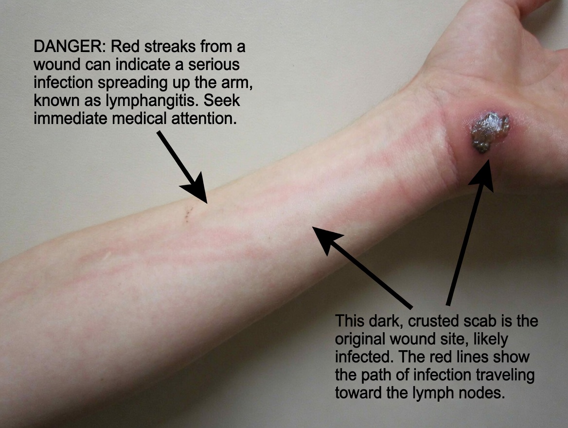 Painful Sore With a Dark Center on the Calf: A Skin Warning You Shouldn’t Ignore