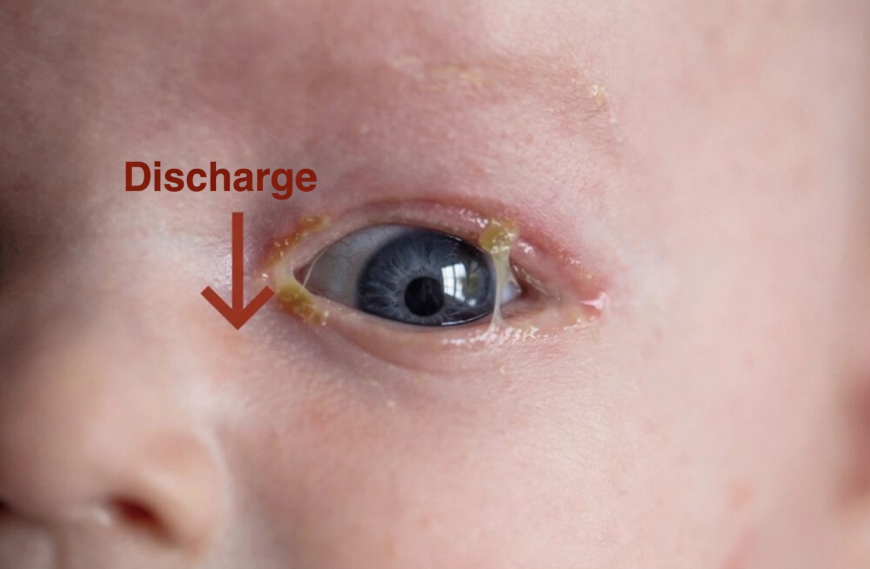 Toddler’s Eye Glued Shut With Yellow Gunk? Gentle Home Cleaning Tips Parents Should Know