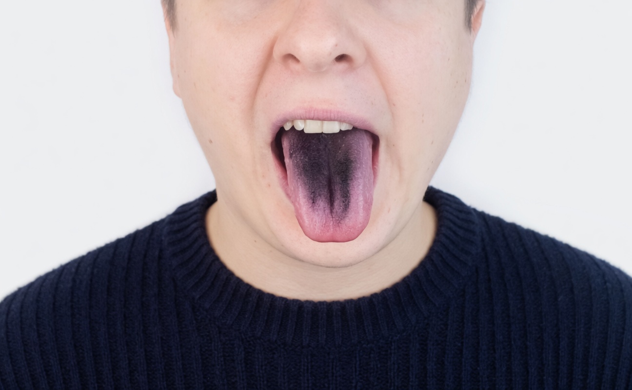 What Does Your Tongue Color Reveal About Your Health Habits