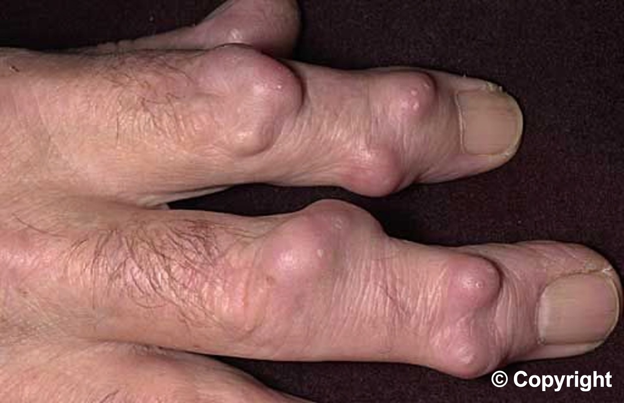 A Strange Lump on the Wrist Overnight? What Older Adults Should Know