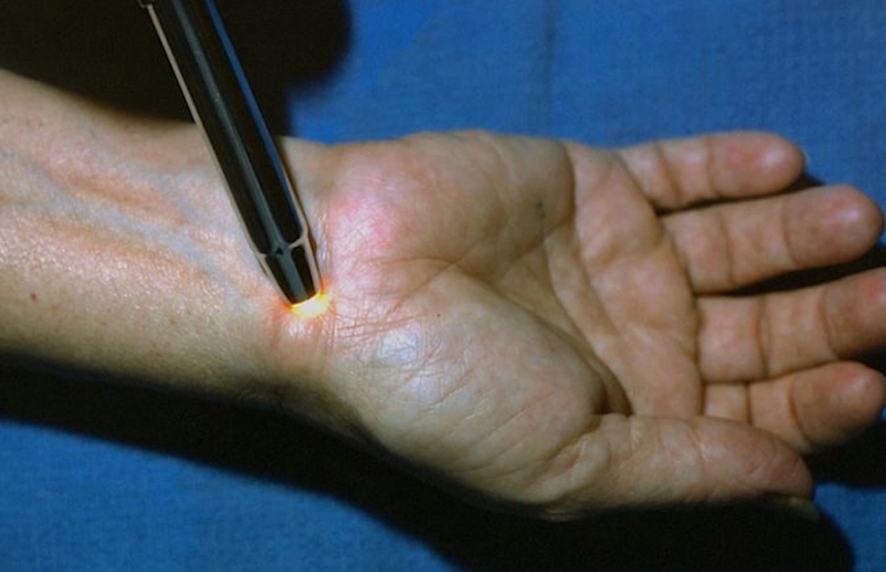 A Strange Lump on the Wrist Overnight? What Older Adults Should Know