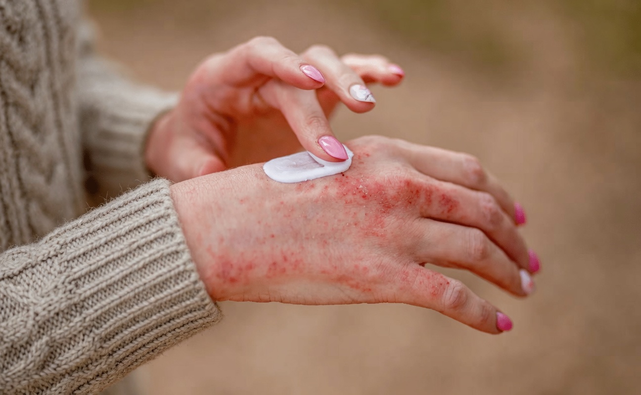 Warning Signs of Hand Dermatitis on Your Hands: Essential Habits and Prevention Tips to Protect Your Skin Barrier