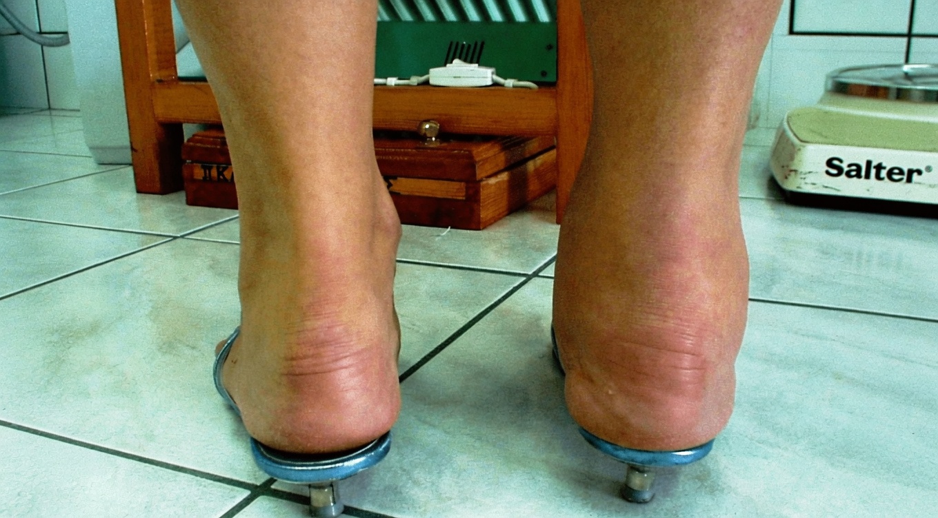 What Causes Swollen Feet and Ankles? Common Reasons and Helpful Steps to Take