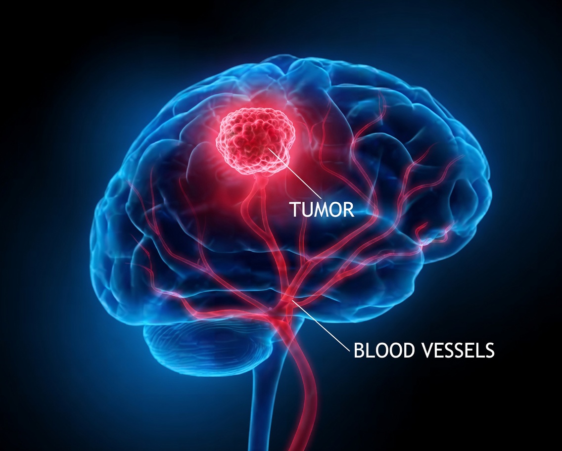 Don’t Miss These 8 Early Warning Signs of a Brain Tumor – Recognizing Them Could Save Your Life