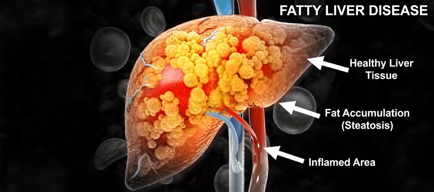 What Is the Most Common Sign of Fatty Liver Disease? Recognizing Fatigue and Other Early Indicators