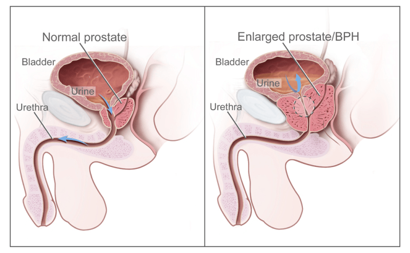 Could Skipping Prostate Cancer Screenings Increase Mortality Risk? Key Insights for Men Over 50