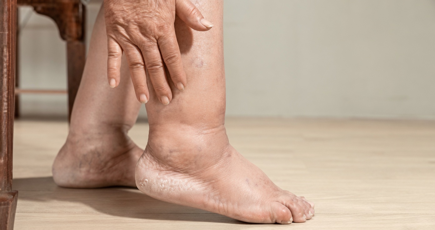 Over 60 Women! These 10 Leg Signs Mean a Stroke Is Coming – Act Before It’s Too Late!