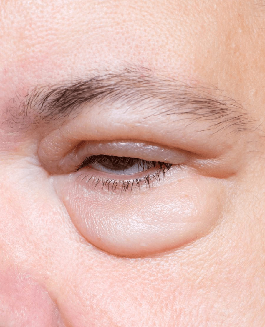 Discovering 12 Subtle Signs That Might Signal Elevated Creatinine Levels and Possible Kidney Health Concerns