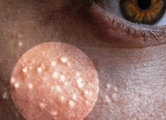 Those Stubborn Little White Bumps: Understanding Milia and Gentle Ways to Support Your Skin’s Appearance