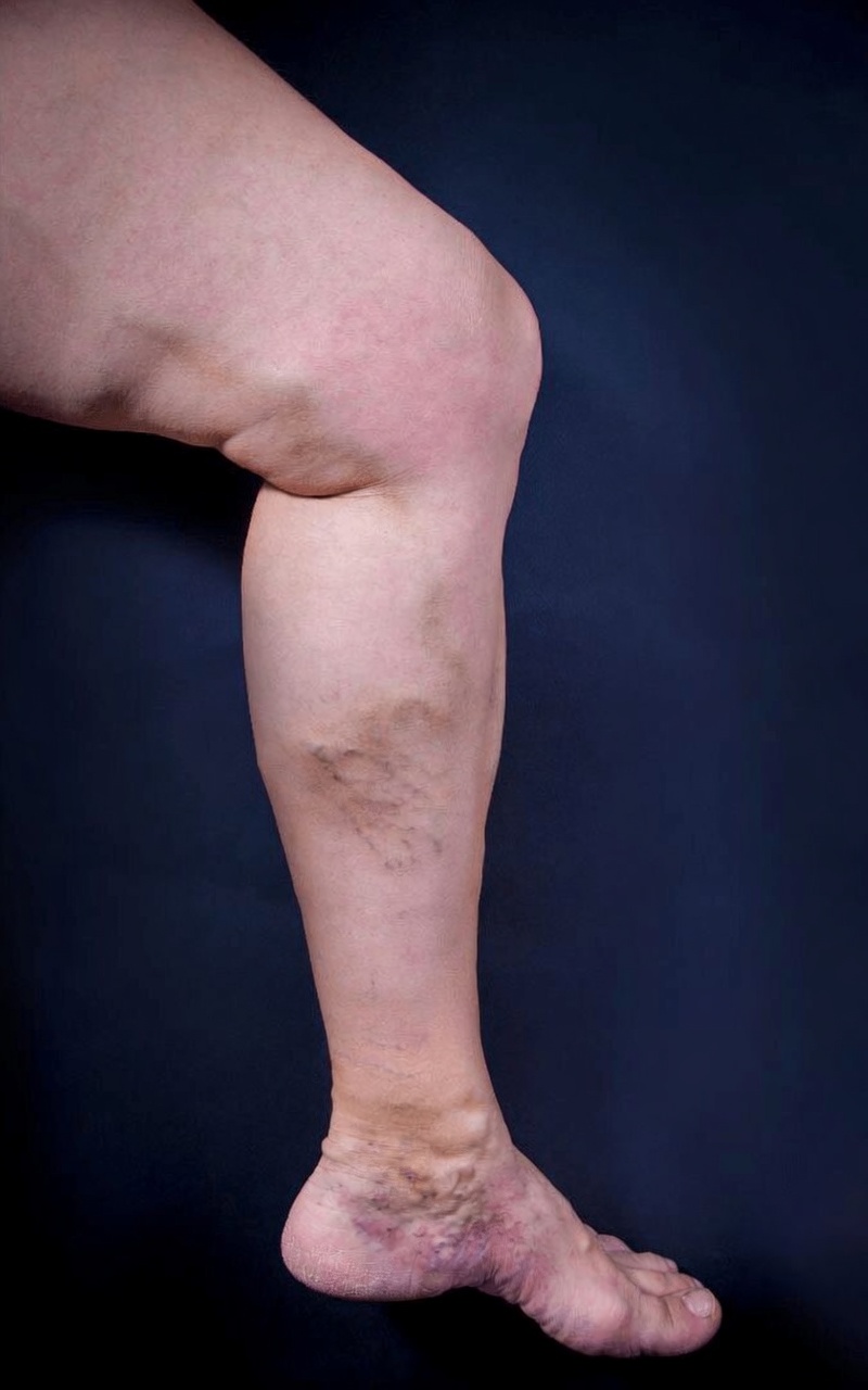 When Bulging Veins May Signal Chronic Venous Insufficiency, Heart and Lung Issues, or Clot Risk