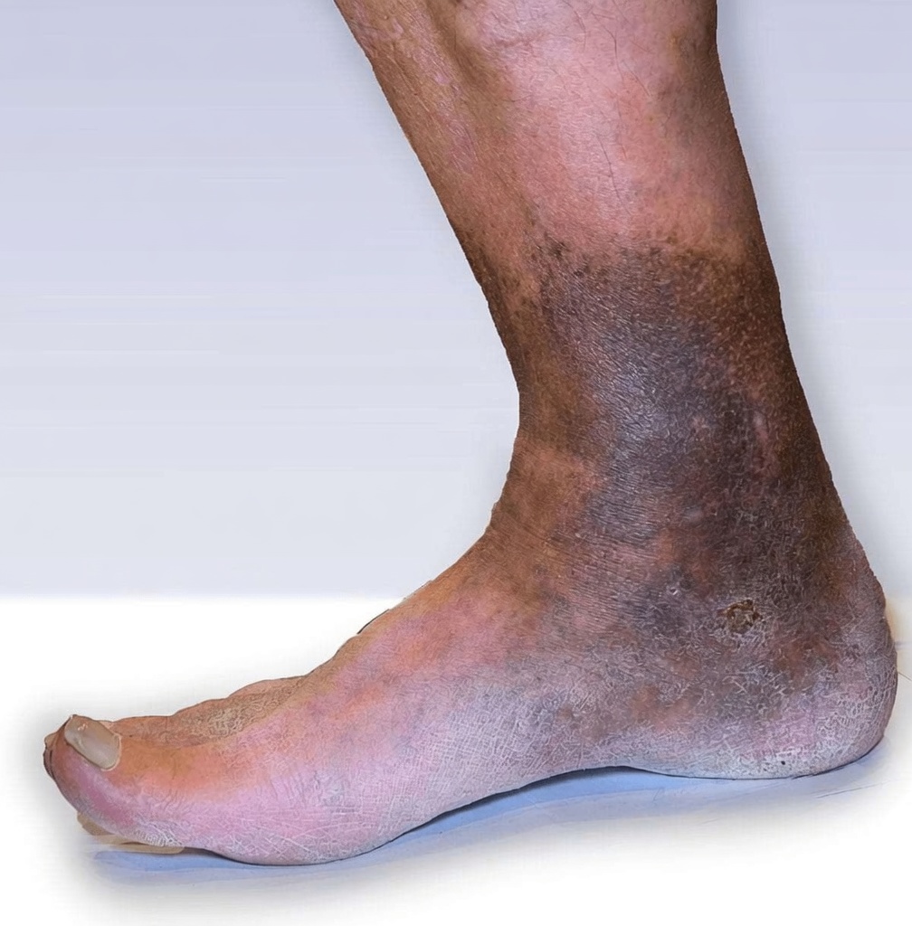 7 Warning Signs of Blocked Arteries in Your Legs and Feet You Should Never Ignore