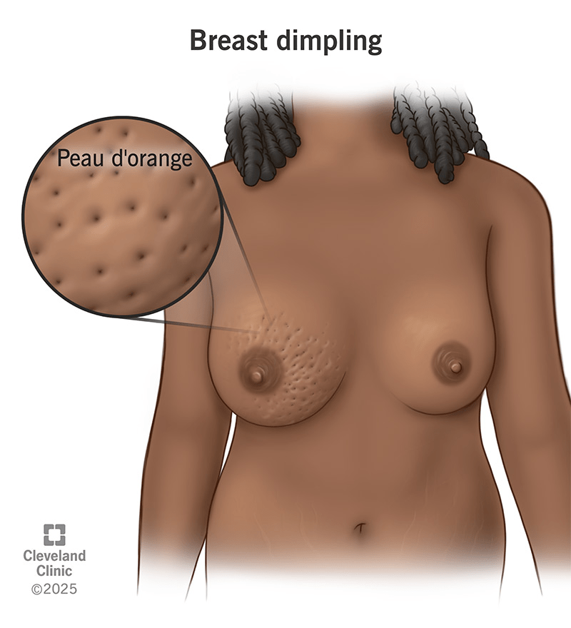 10 Warning Signs of Breast Cancer You Should Never Ignore – Early Detection Can Make a Difference