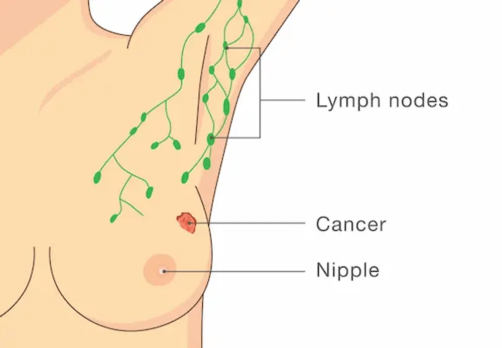 10 Warning Signs of Breast Cancer Every Woman Over 40 Should Know and Monitor