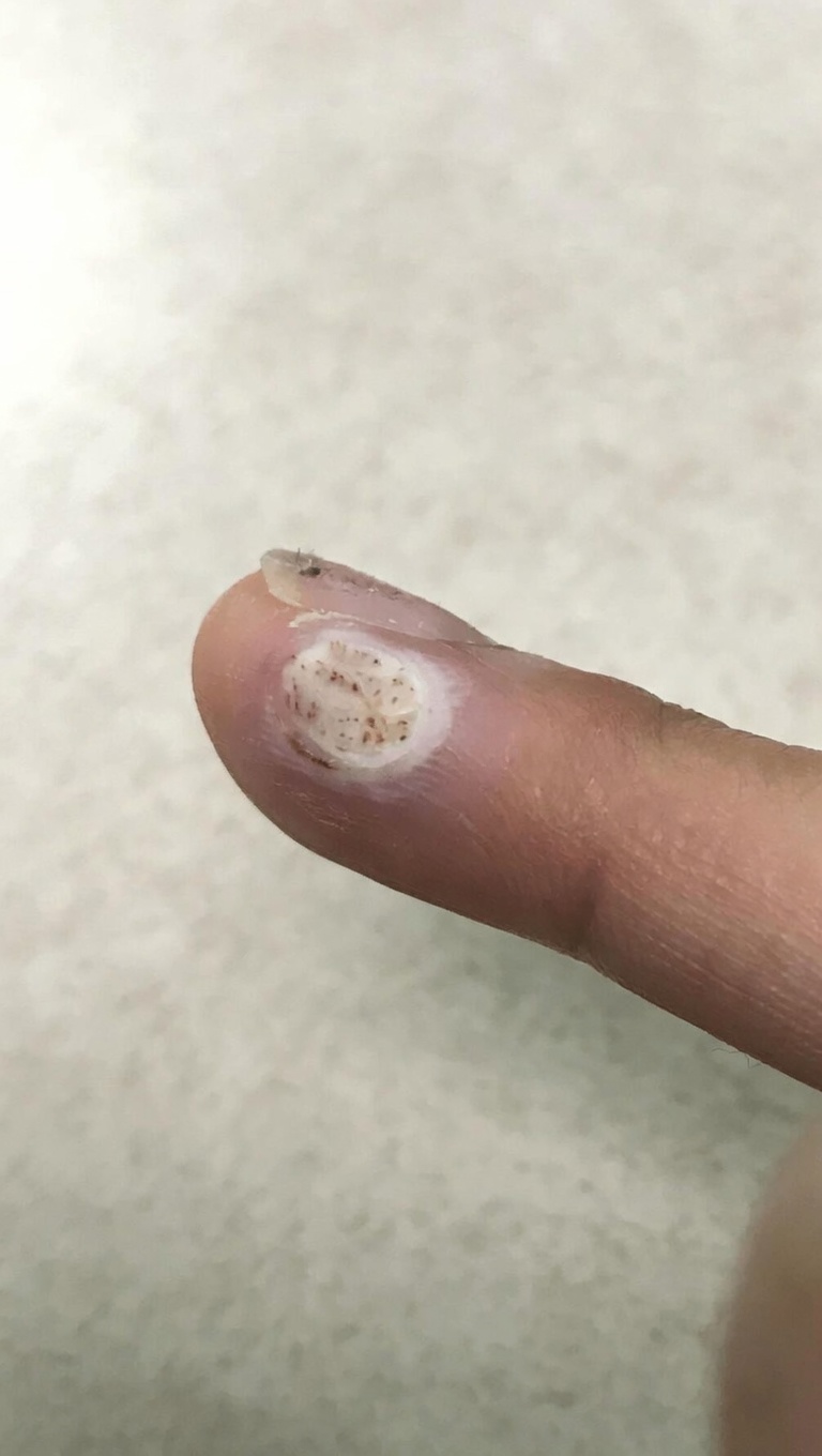 Can Hydrogen Peroxide Help with Warts? Practical Uses, Safety Tips, and What to Expect at Home