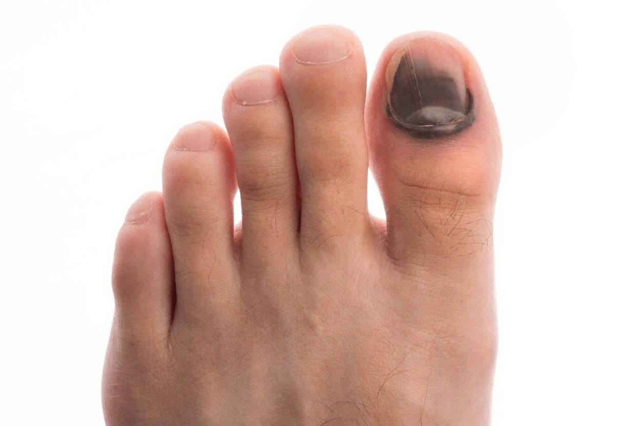 What Your Black Toenail Might Be Telling You: Common Causes and Smart Daily Habits to Consider