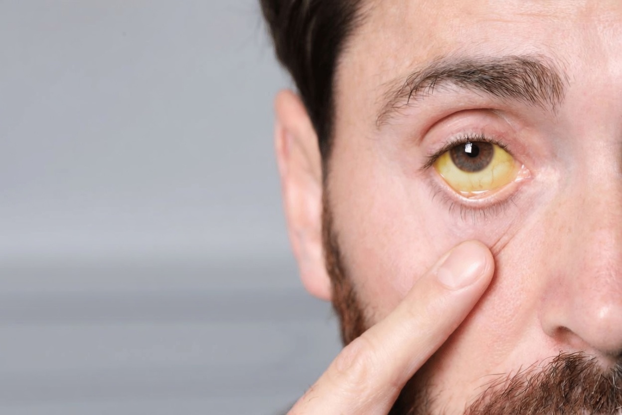 10 Subtle Pancreatic Cancer Warning Signs Many People Over 50 Often Overlook
