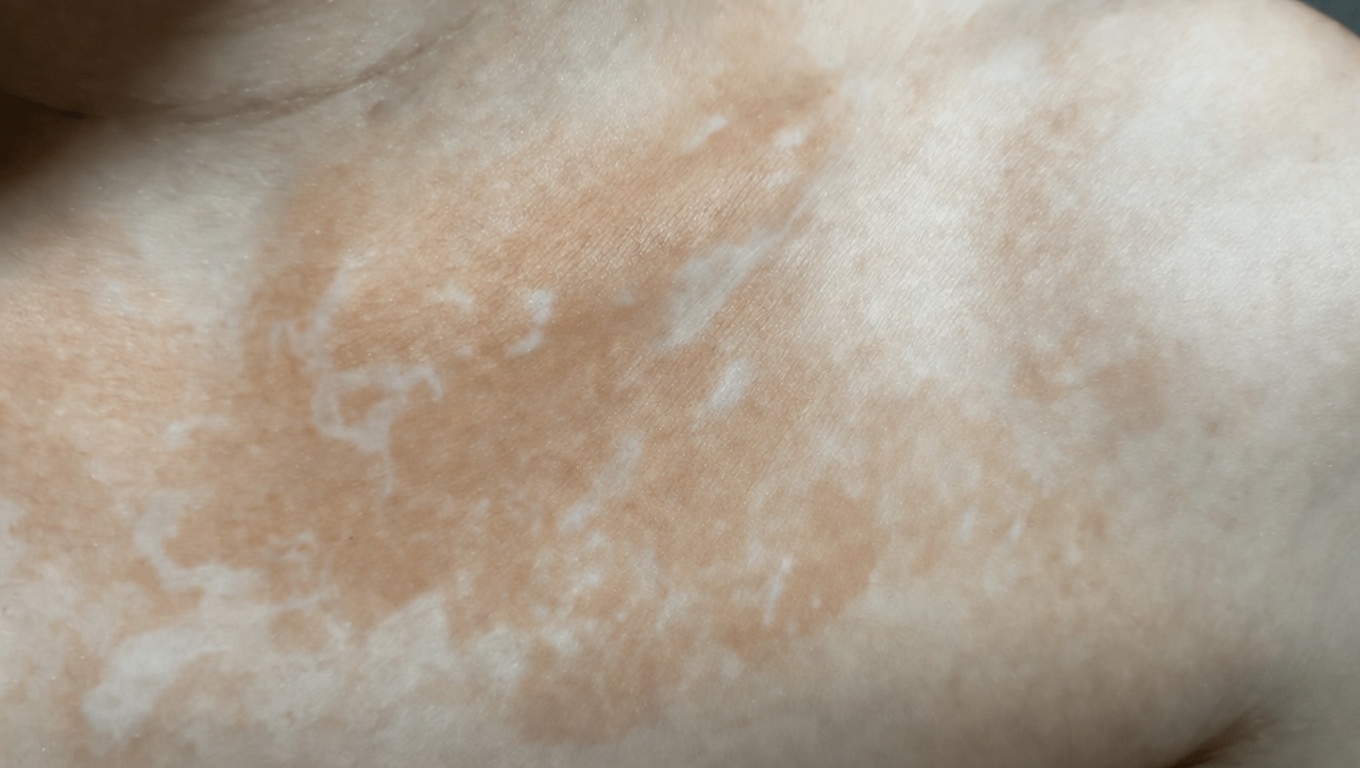 Why Do White Spots Appear on Your Skin? Common Causes and What to Know