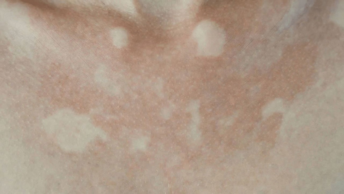 Why Do White Spots Appear on Your Skin? Common Causes and What to Know