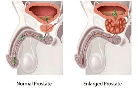 Why Skipping Regular Prostate Checkups May Increase Prostate Cancer Risk in Men Over 40